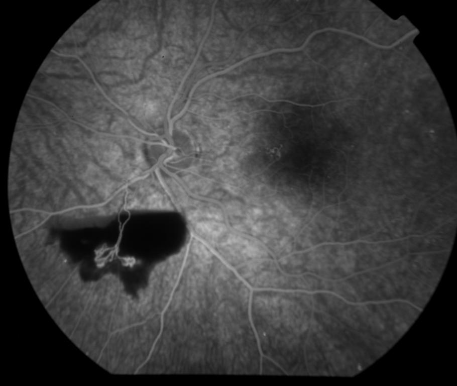 Subhyaloid Hemorrhage | OphEd